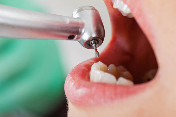 Best Emergency Gum Treatment in Reserve, LA